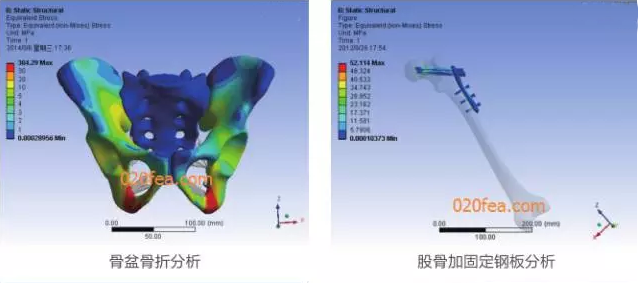 有限元分析法在結(jié)構(gòu)、醫(yī)學(xué)、流體與熱及電場的分析與應(yīng)用